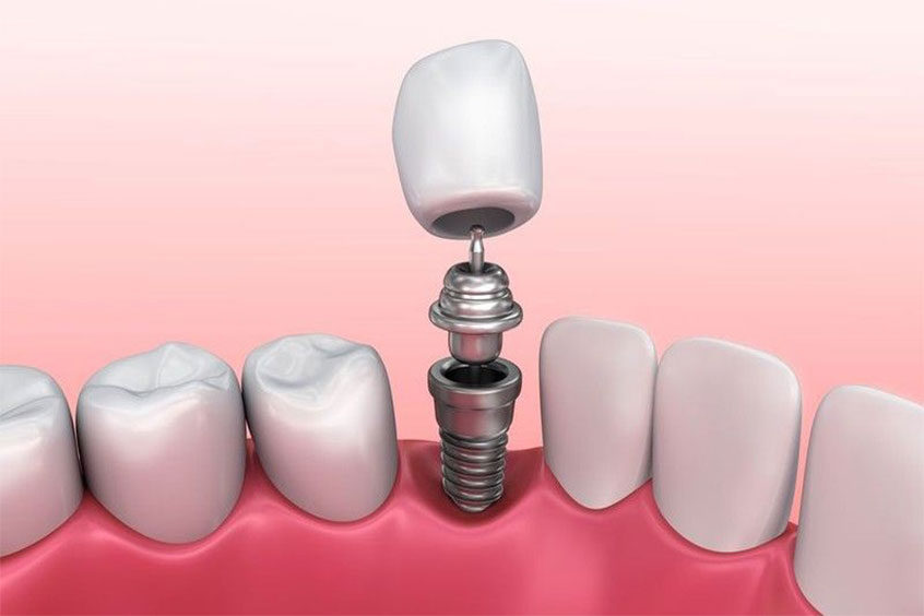Dental Implants- Specialty Dental Service