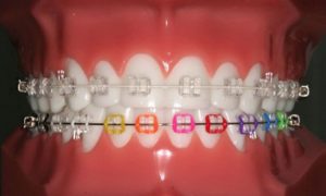 Dental Braces for Child