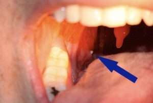 severe halitosis treatment in Airdrie