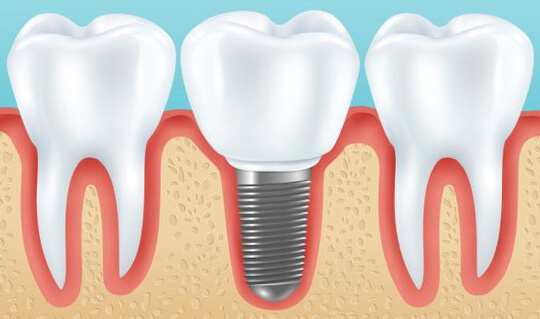 dental_implants_image
