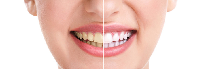 teeth whitening Airdrie dentist
