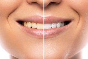 teeth whitening dentist airdrie