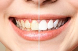 dentist airdrie teeth whitening