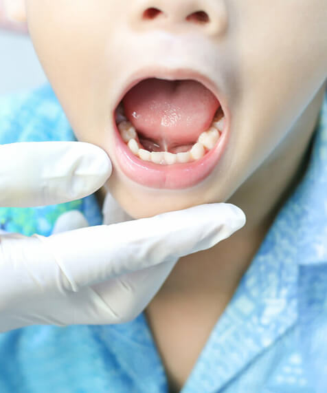 tongue tie causes Airdrie dentist