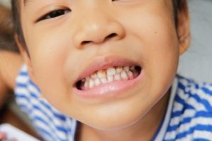 tips from airdrie dentist to prevent tooth decay in kids