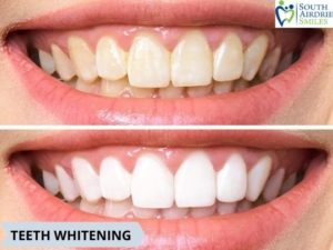 teeth whitening in Airdrie