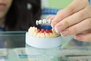 maximizing dental bonding longevity