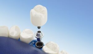 dental implants in airdrie