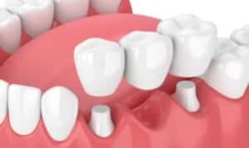 Dental Crowns in Airdrie, AB