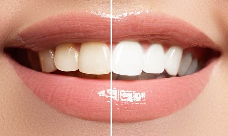 Teeth Whitening In Airdrie, AB