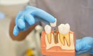 7 common myths about dental implants in airdrie - south airdrie smiles