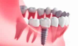 dental implants in preventing bone loss airdrie ab - south airdrie smiles