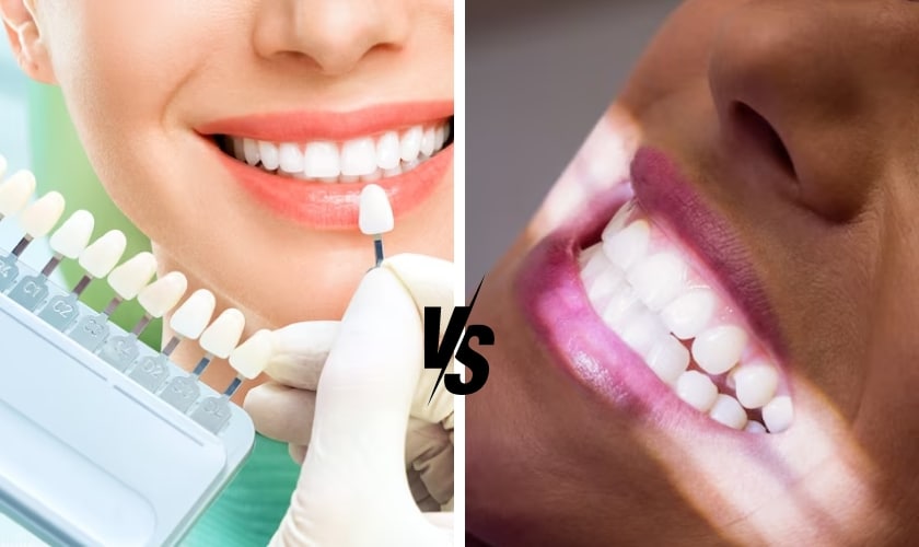 dental bonding vs porcelain veneers which is right for you south airdrie smiles dentist explains
