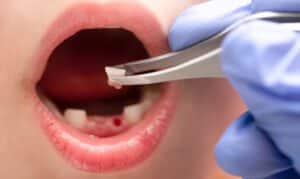 knocked-out tooth, avulsed tooth, tooth replacement, emergency dentist in Airdrie, emergency dental care in Airdrie