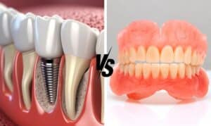 dentist at South Airdrie Smiles explains the pros and cons of dental implants vs dentures