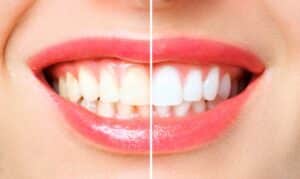 teeth whitening tips, cosmetic dentist airdrie, teeth whitening airdrie, in-house teeth whitening airdrie, teeth bleaching airdrie, sensitive teeth teeth whitening airdrie