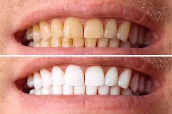 grey teeth diagnosis causes treatment