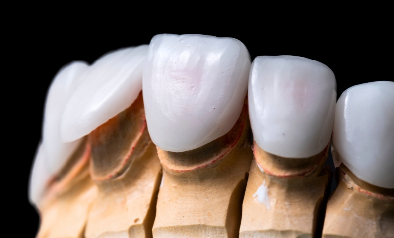 veneers for fixing chipped teeth