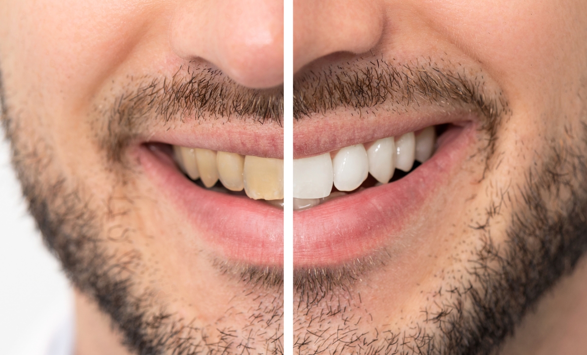 effectiveness of dentists teeth-whitening