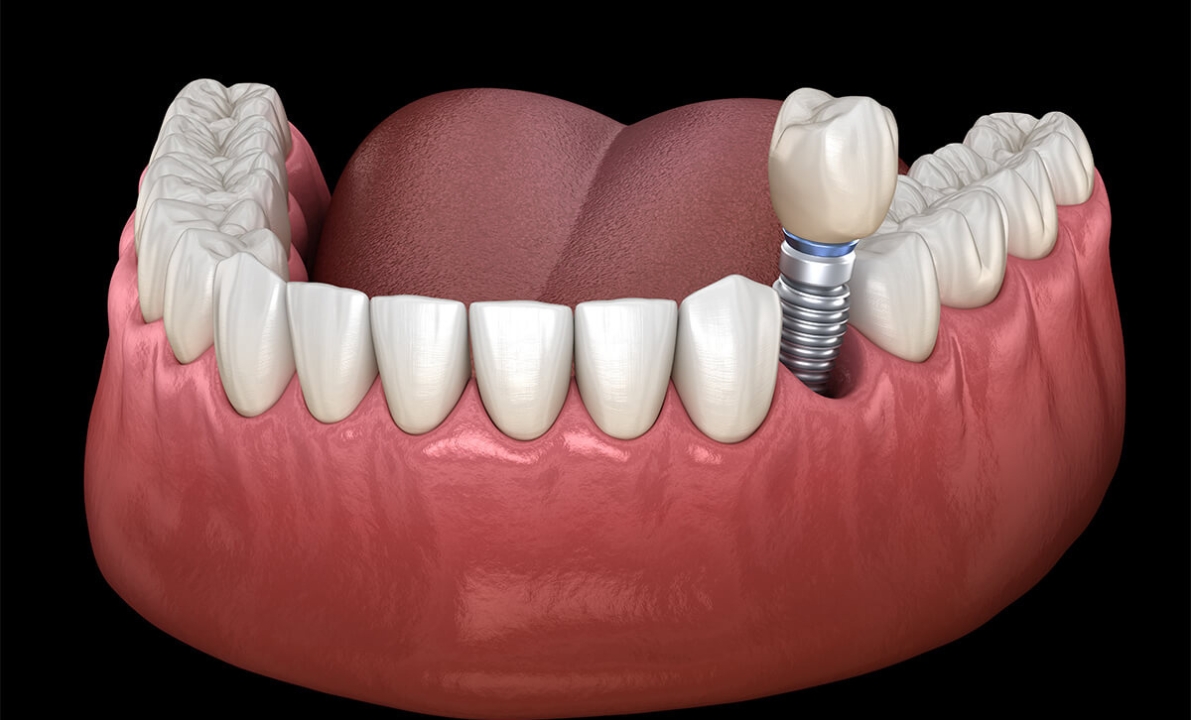 Dental Implant Surgery Recovery Time Explained